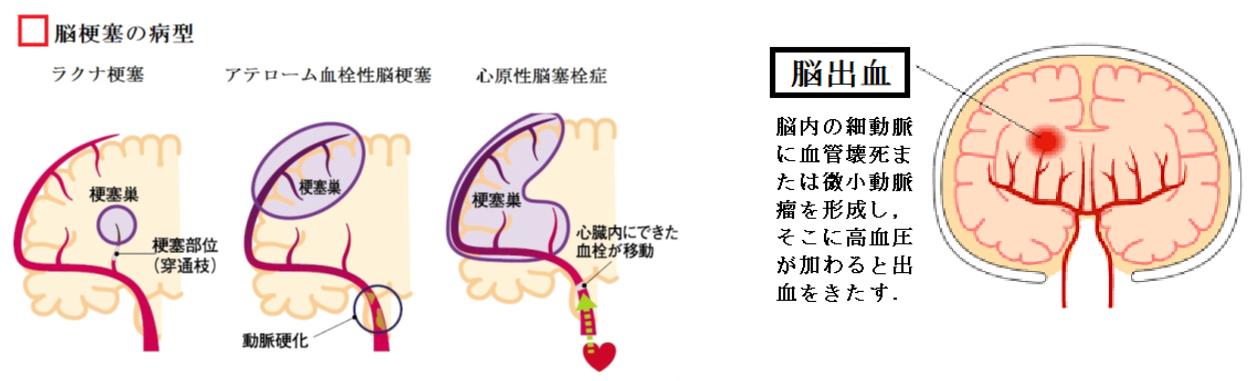 脳梗塞の病型